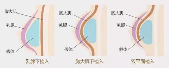 最新隆胸方法探索，现代丰胸技术的新领域